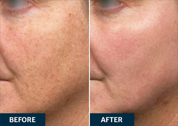 Before and After ActiveFX laser treatment