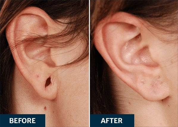 Before and After an earlobe repair