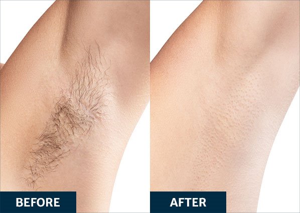 Before and after Splendor X Laser Hair Removal treatment on armpit