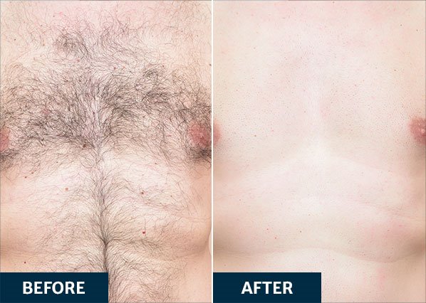 Before and after Splendor X Laser Hair Removal treatment on chest