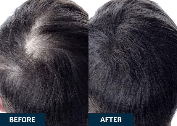 Before and after platelet-rich fibrin treatment on hair