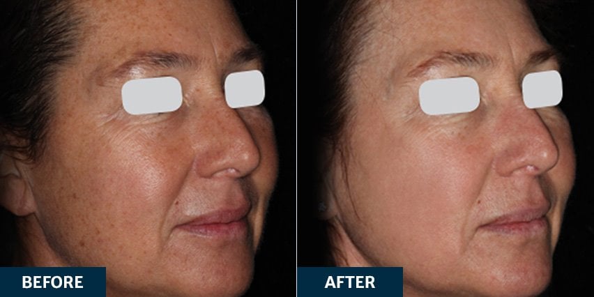 Before and after ResurFX Skin Resurfacing treatment