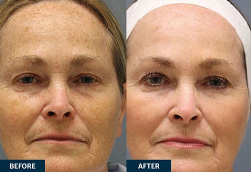 Before and after Legend M2 Microneedling with RF treatment
