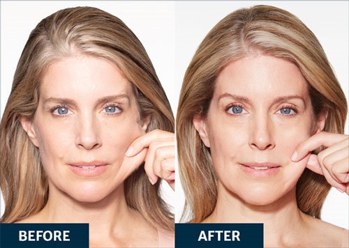 Before and after Sculptra collagen treatment