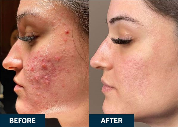 Before and after Smoothglo treatment