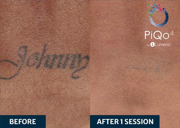 Before and after PiQo4 Laser Treatment on tattoo