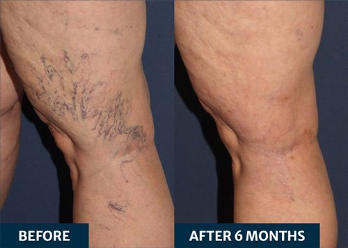 Sclerotherapy treatment before and after 6 months