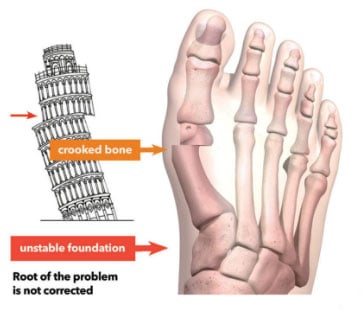 Explanation of Traditional bunion surgery