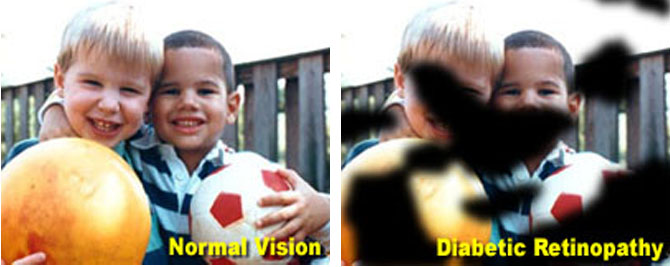 Diabetic Retinopathy Screenings - Austin Regional Clinic